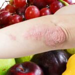 psoriatic arthritis on the arm with fruits to help heal